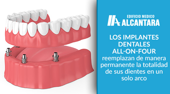 Implantes Dentales con All On FOur