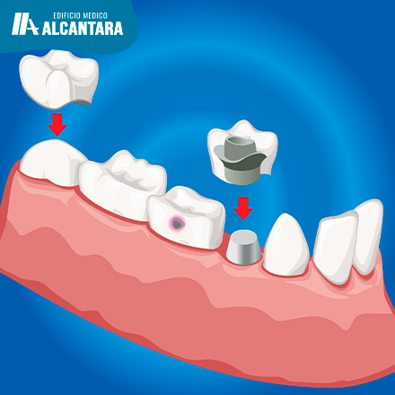 Diferencias entre una Corona Sobre un Diente Natural y una Sobre Implante Dental