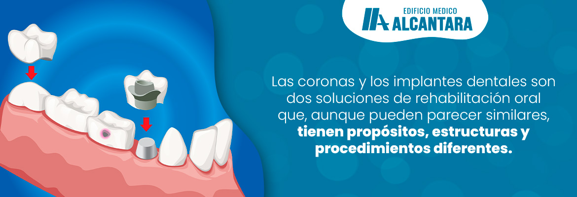 Diferencias entre una Corona Sobre un Diente Natural y una Sobre Implante Dental