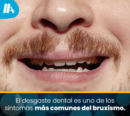 El Desgaste Dental es un Signo Clave de Bruxismo Nocturno