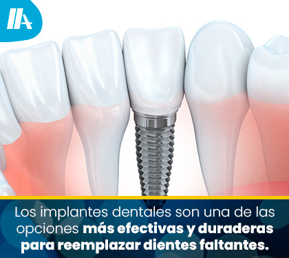 Implante Dental Reemplaza Diente Faltante